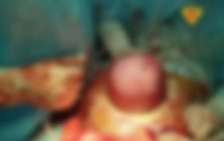 В Обнинске женщина смогла родить с 6-сантиметровой миомой