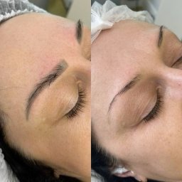 Удаление татуажа - 3 000 руб. Удаление татуажа - 3 000 руб.