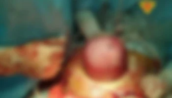 В Обнинске женщина смогла родить с 6-сантиметровой миомой